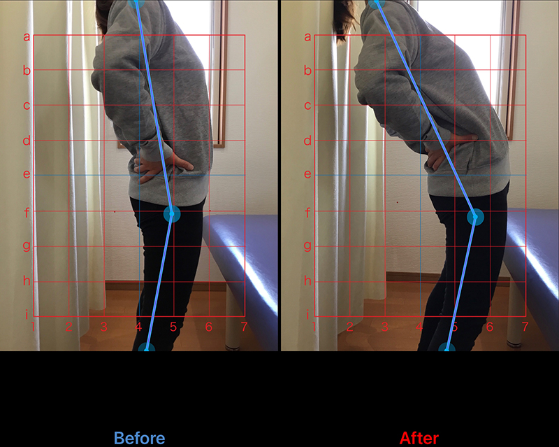 20代 女性 腰椎ヘルニア